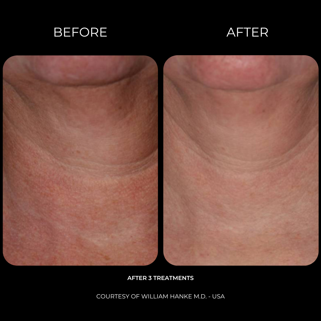 SmartxidePro_Before&After