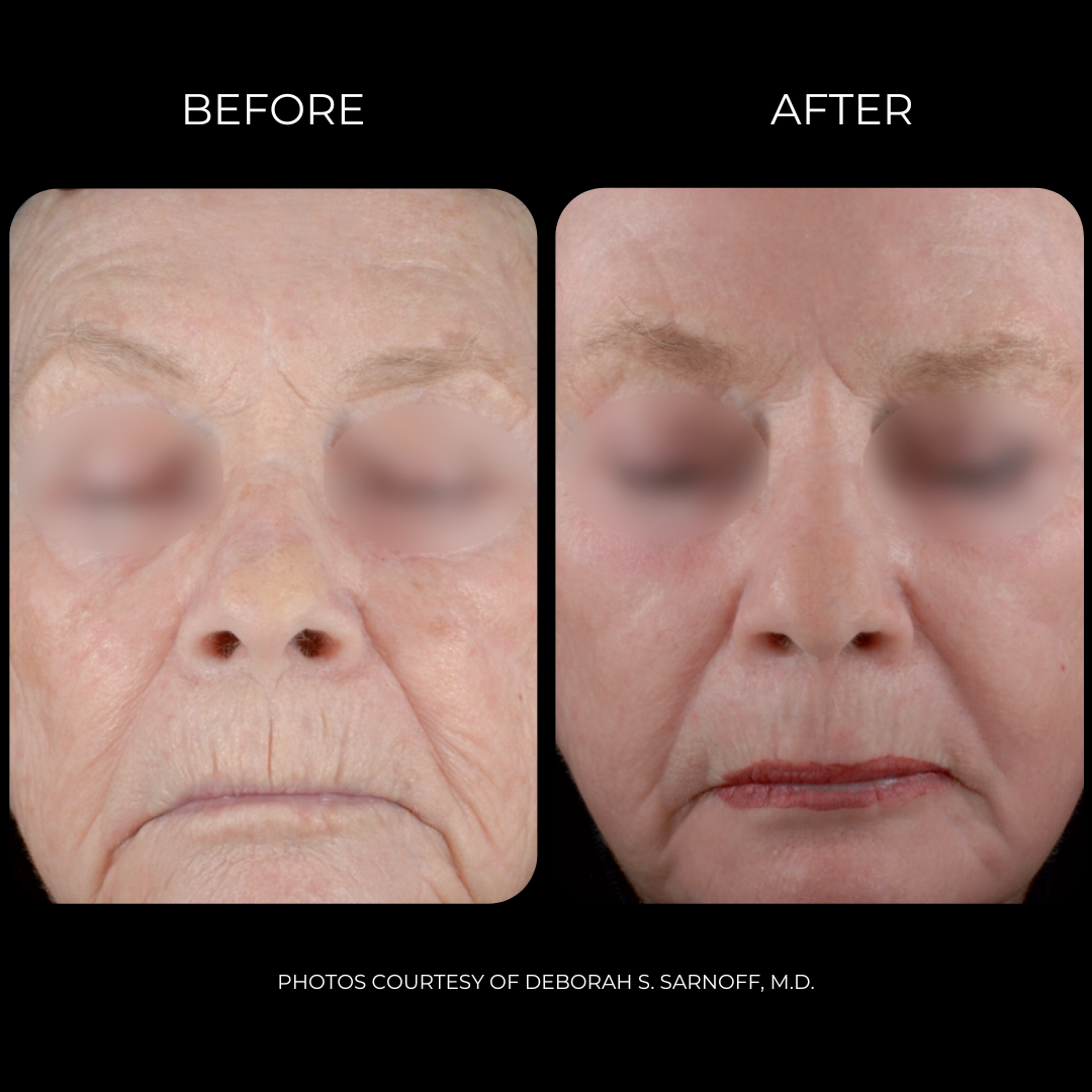 SmartxidePro_Before&After2