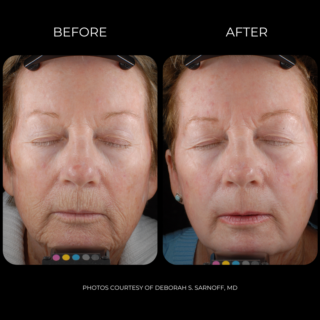 SmartxidePro_Before&AfterSmartxidePro_Before&After