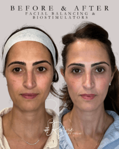Facial Balancing, Massetter Botox, Sculptra Before and After at Refine by Tulsi in Chicago