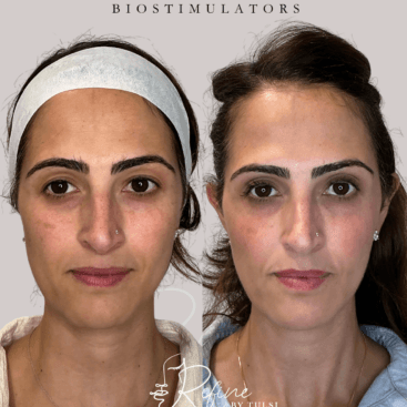 Facial Balancing, Massetter Botox, Sculptra Before and After at Refine by Tulsi in Chicago