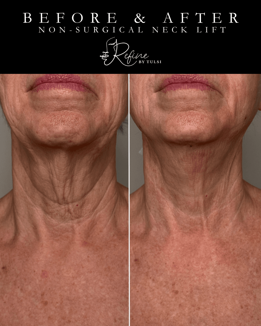 Nonsurgical face lift to fix crepy neck