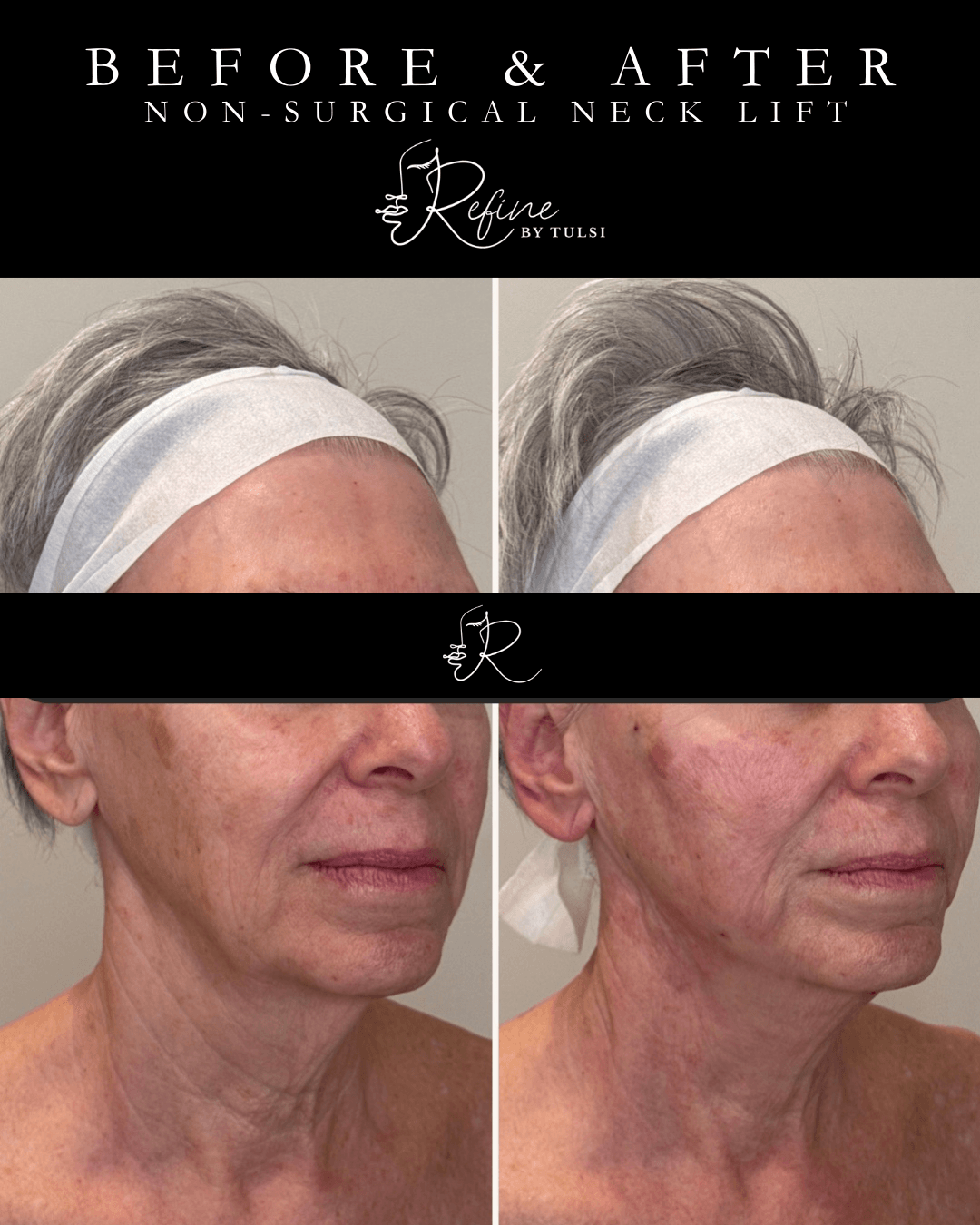 Nonsurgical face lift to fix jowling