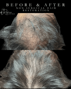 Before and after male hair restoration using PRF and GHK-Cu peptides in Chicago at Refine by Tulsi