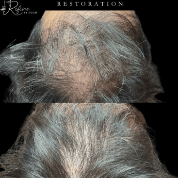 Before and after male hair restoration using PRF and GHK-Cu peptides in Chicago at Refine by Tulsi
