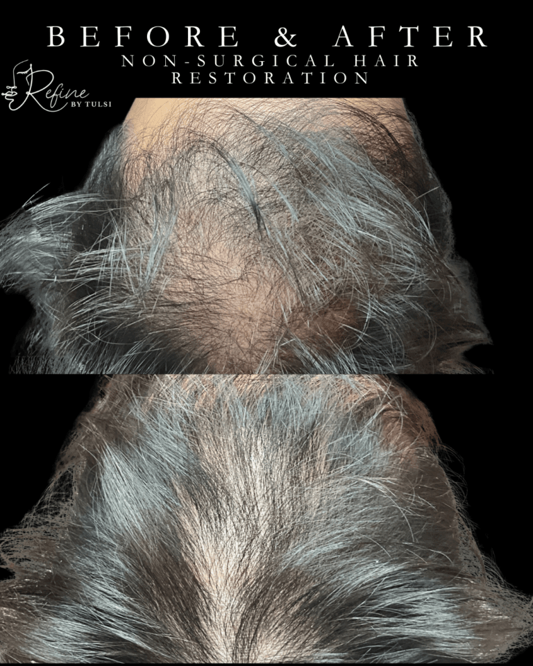 Before and after male hair restoration using PRF and GHK-Cu peptides in Chicago at Refine by Tulsi