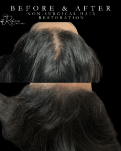 Menopausal Hair Loss Treatment at Refine by Tulsi using PRP, Exosomes and Microneedling in Chicago Best Med Spa