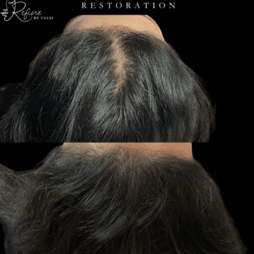 Menopausal Hair Loss Treatment at Refine by Tulsi using PRP, Exosomes and Microneedling in Chicago Best Med Spa