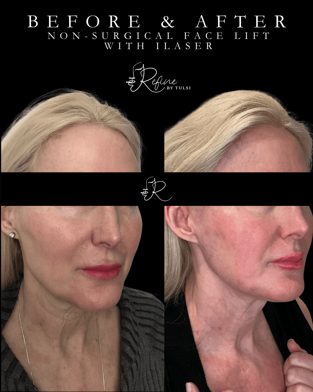 No more jowling using Ilaser at Refine by Tulsi