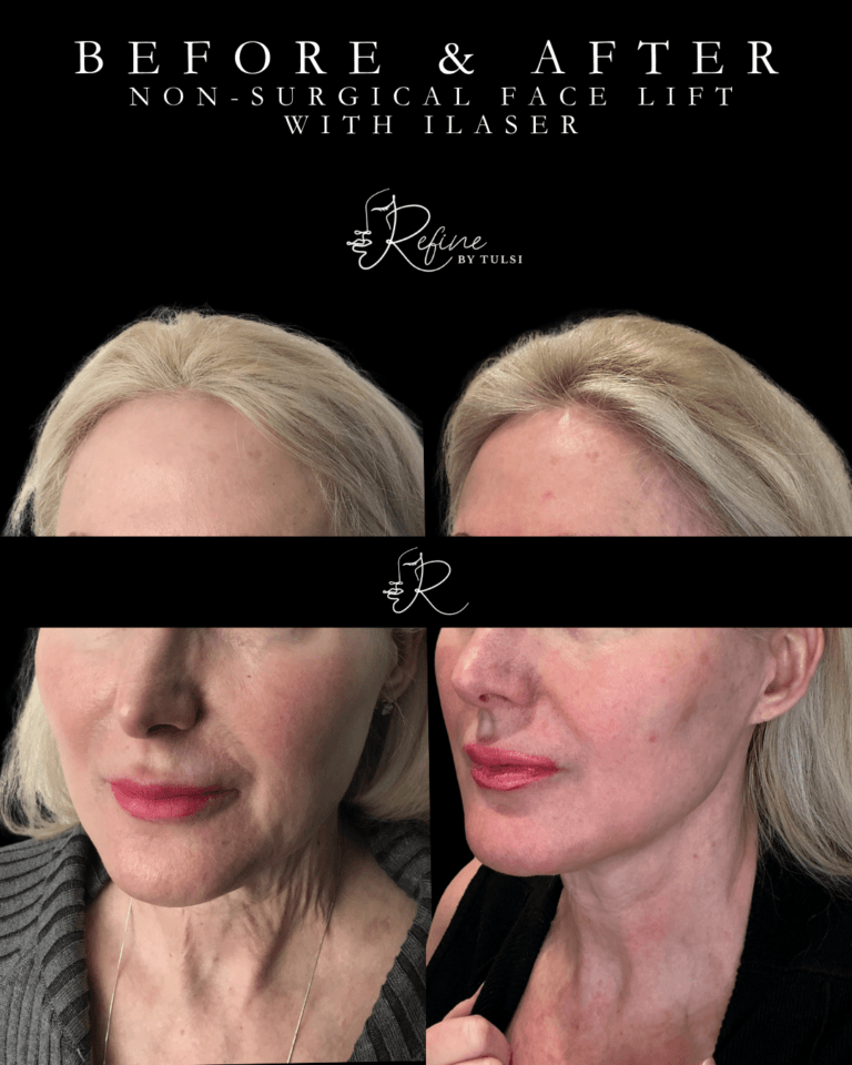 Non-Surgical Face Lift - Neck Wrinkles and Sagging Skin corrected