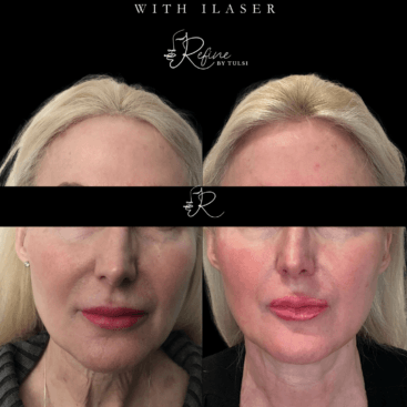 Face tightening and contouring use Ilaser for Non-Surgical Face Lift