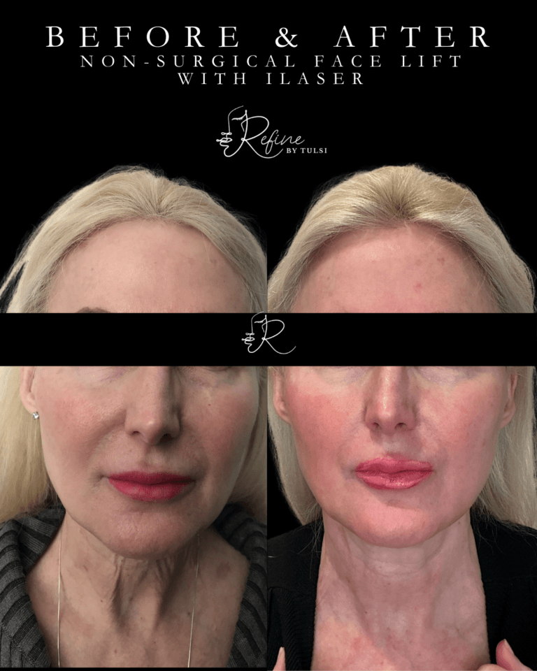 Face tightening and contouring use Ilaser for Non-Surgical Face Lift