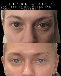PRF EZ Gel Under Eye Treatment At Chicago's Best Med Spa - Refine by Tulsi