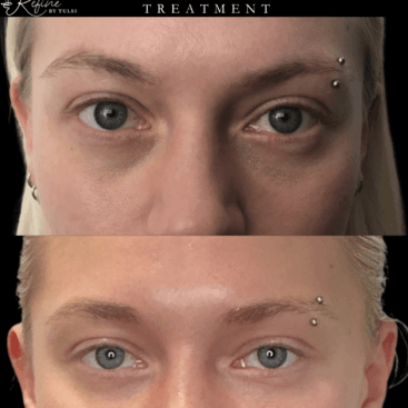 PRF EZ Gel Under Eye Treatment At Chicago's Best Med Spa - Refine by Tulsi