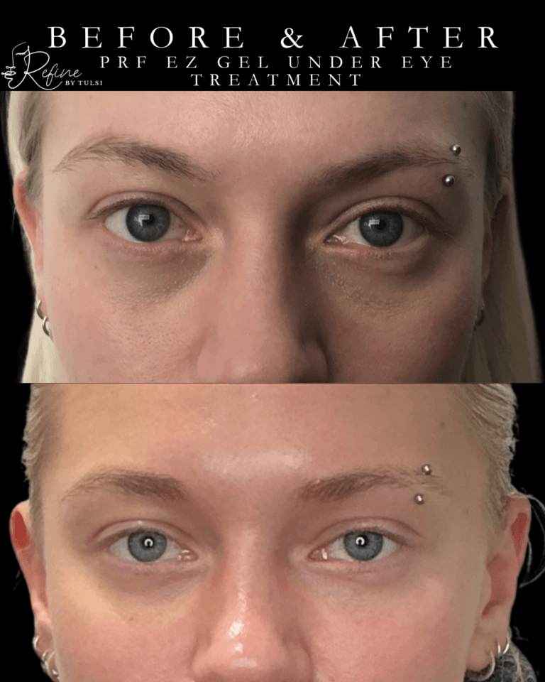 PRF EZ Gel Under Eye Treatment At Chicago's Best Med Spa - Refine by Tulsi