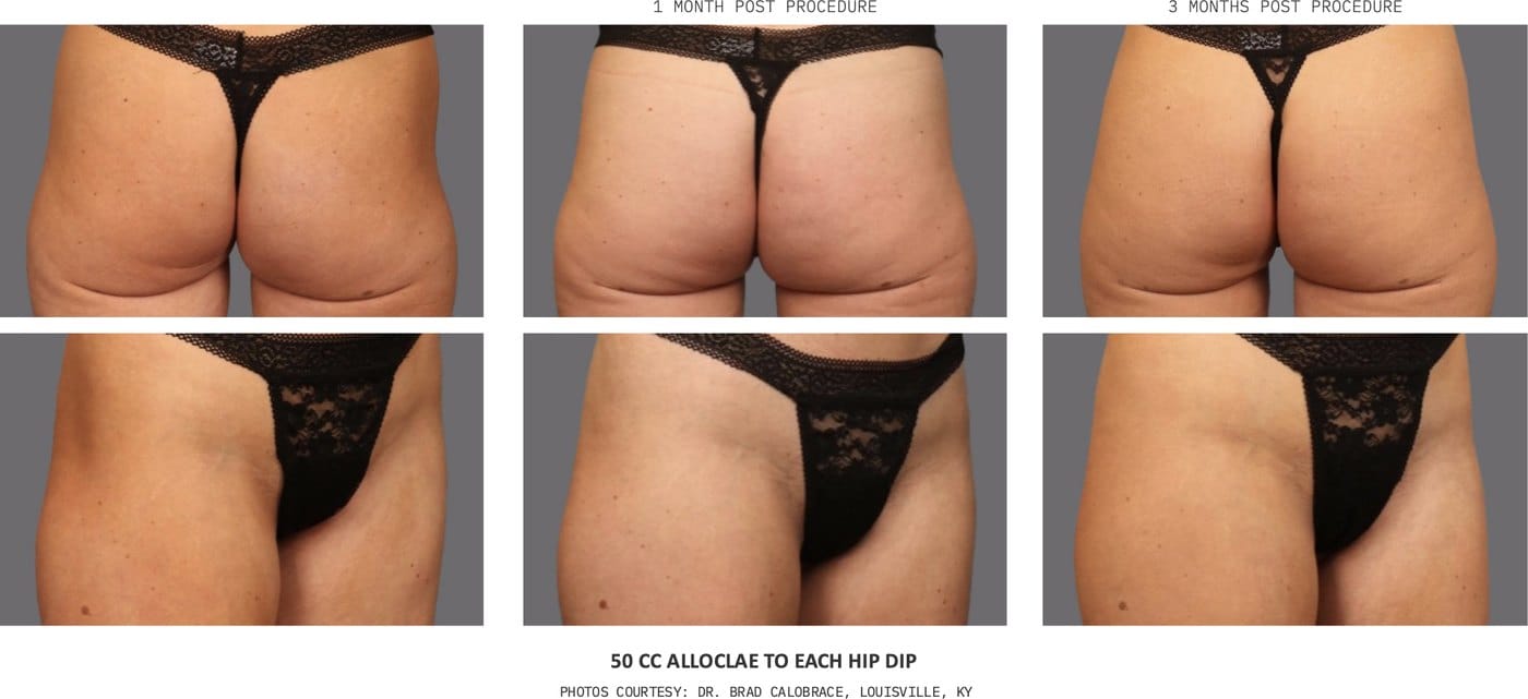 alloClae hip dip before and after, 50cc to each hip dip, before, 1 month and 3 months post-procedure — photos courtesy of Dr. Brad Calobrace, Louisville, KY