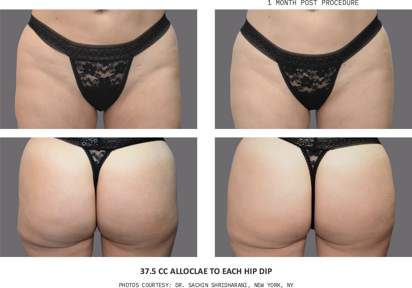 alloClae hip dip before and after, 37.5cc to each hip dip, one month post-procedure — photos courtesy of Dr. Sachin Shridharani, New York, NY