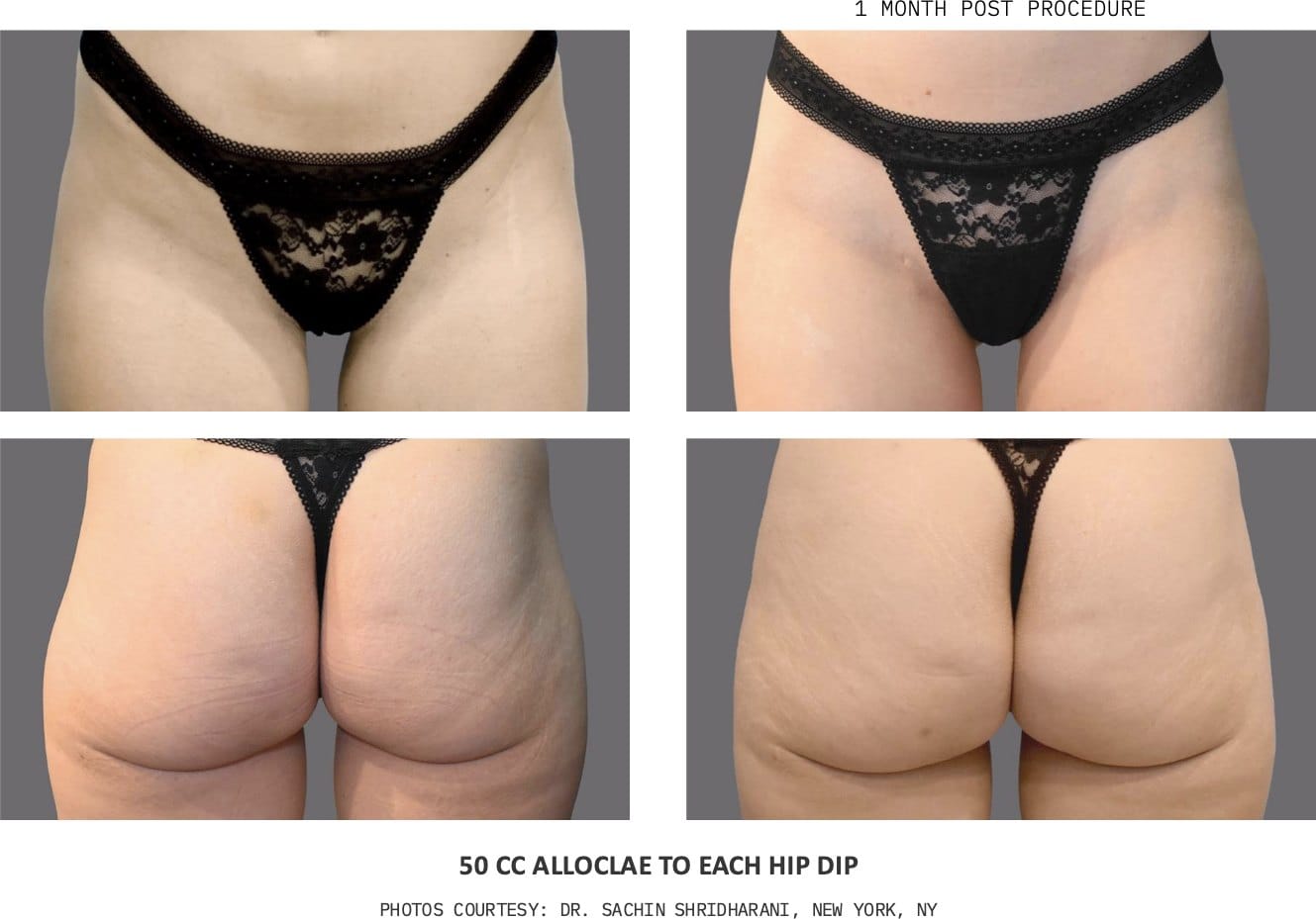 alloClae hip dip before and after, 50cc to each hip dip, one month post-procedure — photos courtesy of Dr. Sachin Shridharani, New York, NY