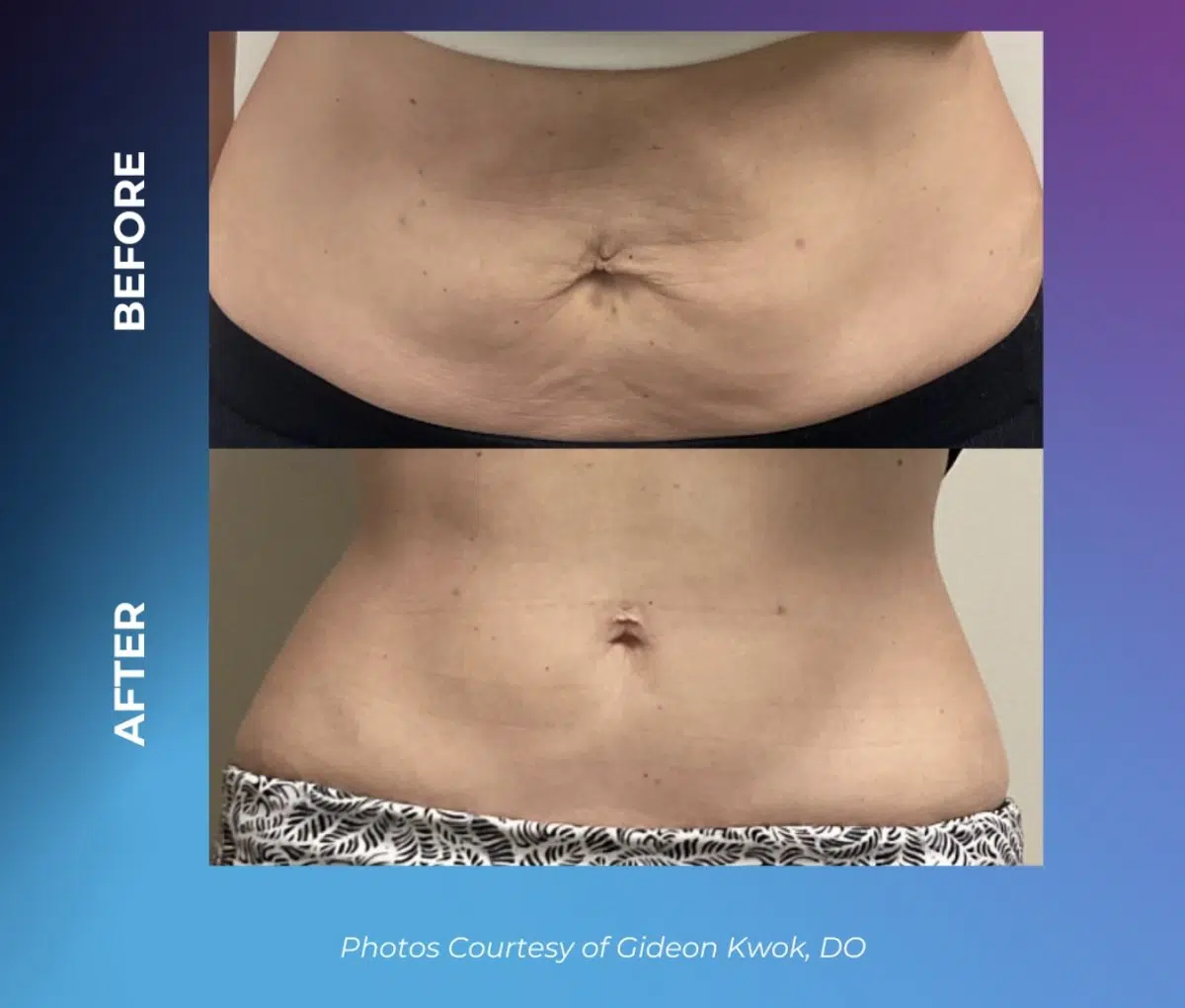 Non-Surgical Body Contouring & Skin Tightening in Chicago