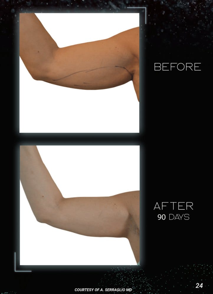 Arm before and after iLaser skin tightening, 90 days — photos courtesy of A. Serraglio, MD
