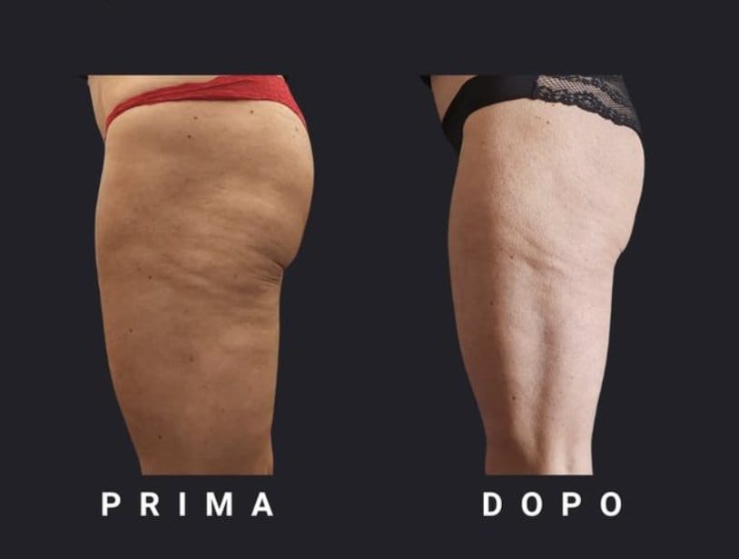 Thigh cellulite before and after non-surgical treatment