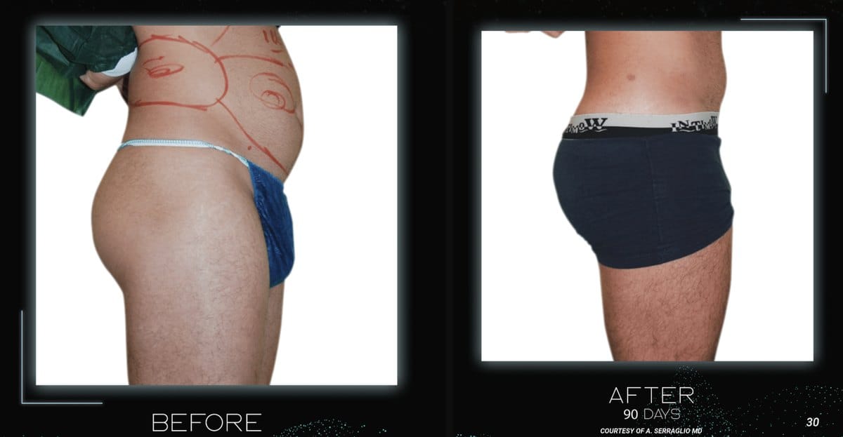 Flank and waist before and after iLaser body sculpting, 90 days — photos courtesy of A. Serraglio, MD