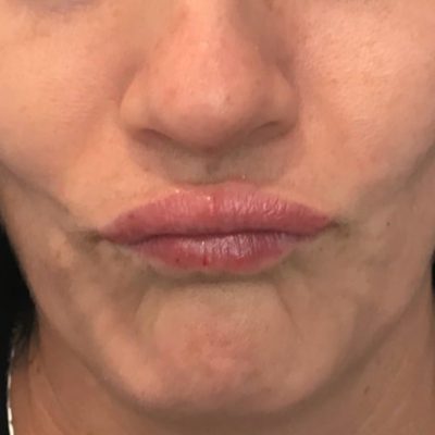 After image showing reduced barcode lines around the lips following dermal filler treatment.