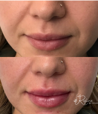 Before & After Lip Filler Transformation with Singature Tulsi Lips at Refine by Tulsi Medspa in Chicago