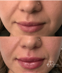 Before & After Lip Filler Transformation with Singature Tulsi Lips at Refine by Tulsi Medspa in Chicago