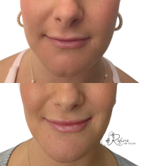 Before and After Filler for Lips and Face for Lip Enhancement and Facial Balancing Treated at Refine by Tulsi Med Spa Chicago